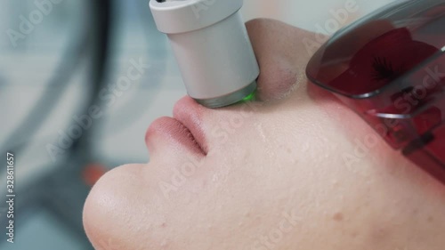 Close up of lips area on woman face during laser hair removal procedure