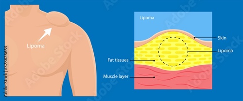 Lipoma disease tissue fatty grows body skin soft hurt pain madelung diagnose physical exam biopsy test 