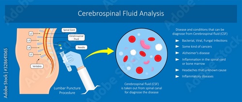 lumbar puncture spinal tap canal diagnostic collect sample patient treat MS tumor exam drug measure pressure CSF lab white blood cell fluid barre back sclerosis cerebri cord hemorrhage column