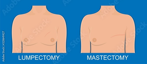 Mastectomy breast cancer axillary lymph node dissection chance prevent risk mammography recovery detect diagnosis mammogram symptom infection fluid swelling pain hormonal life bruise bleeding illness
