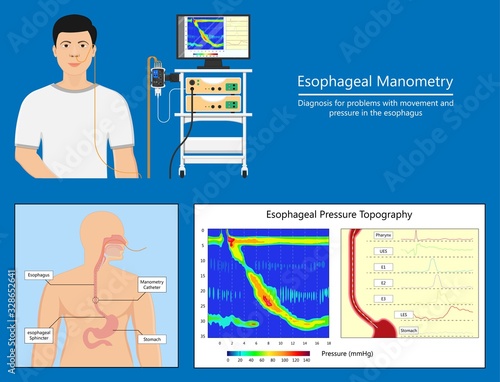 Esophageal manometry test esophageal diagnose food high resolution impedance HRM difficulty swallowing Achalasia treat acid