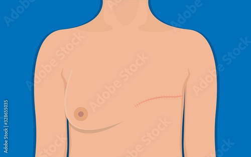 mastectomy breast cancer axillary lymph node dissection chance prevent risk mammography recovery detect diagnosis mammogram symptom infection fluid swelling pain hormonal life bruise bleeding illness