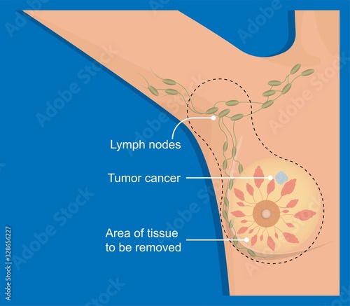 mastectomy breast cancer axillary lymph node dissection chance prevent risk mammography recovery detect diagnosis mammogram symptom infection fluid swelling pain hormonal life bruise bleeding illness