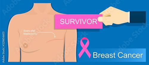 mastectomy breast cancer axillary lymph node dissection chance prevent risk mammography recovery detect diagnosis mammogram symptom infection fluid swelling pain hormonal life bruise bleeding illness