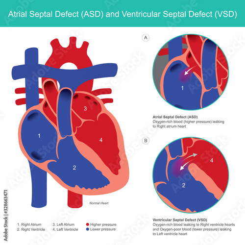 Atrial Septal Defect (ASD) and Ventricular Septal Defect (VSD). Abnormal of the heart atrial and heart ventricle from baby birth.