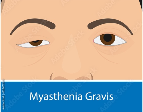 Myasthenia gravis (MG) disease treatment diagnosis testing Electroneuromyography Bell’s palsy Electromyogram problem muscular Motor Carpal tunnel syndrome Cubital Guillain Barre Peripheral neuropathy