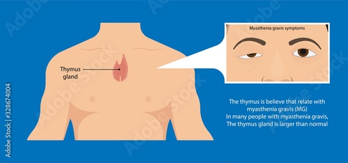 Myasthenia gravis (MG) disease treatment diagnosis testing Electroneuromyography Bell’s palsy Electromyogram problem muscular Motor Carpal tunnel syndrome Cubital Guillain Barre Peripheral neuropathy