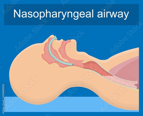 Suction patient adult nares unit lung clear fluid tube nose nasal pump treat nurse airway clinic device portable mucus oxygen emergency examination therapy sick anaesthetist pharynx pneumonia breathe