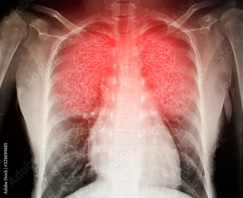 Foto Virus destroys human lungs the lnflamed a radiograph