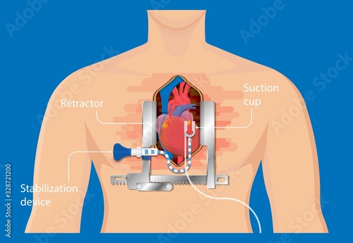 Coronary artery bypass grafting CABG open heart surgery surgical blocked fatty material forms transplant operation attack beating CAD treat CPB