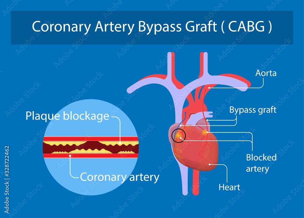 Coronary artery bypass grafting CABG open heart surgery surgical blocked fatty material forms