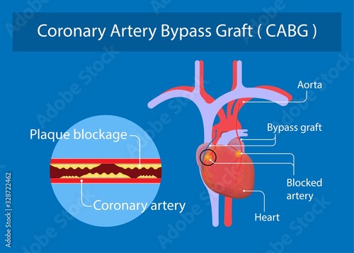 Coronary artery bypass grafting CABG open heart surgery surgical blocked fatty material forms transplant operation attack beating CAD treat CPB