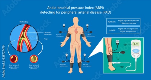 Peripheral artery disease ankle brachial index ABI test limb ischemia diagnosis vascular ABPI blockage photo