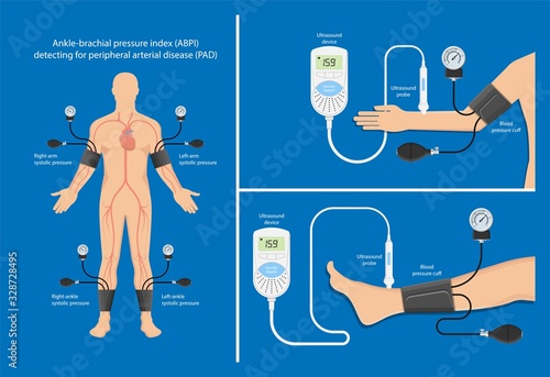 Peripheral artery disease ankle brachial index ABI test limb ischemia diagnosis vascular ABPI blockage