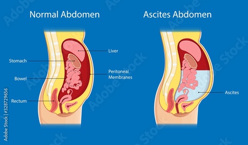Ascites Paracentesis medical procedure diagnostic abdominal bacteria treatment therapy drainage photo