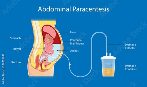 Ascites Paracentesis medical procedure diagnostic abdominal bacteria treatment therapy drainage