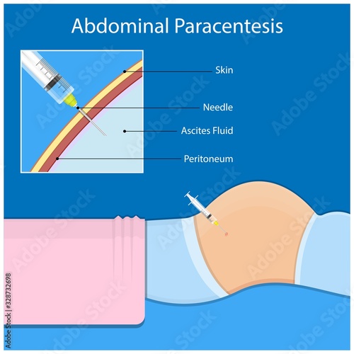 Ascites Paracentesis medical procedure diagnostic abdominal bacteria treatment therapy drainage