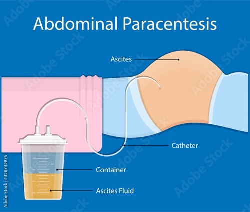 Ascites Paracentesis medical procedure diagnostic abdominal bacteria treatment therapy drainage photo