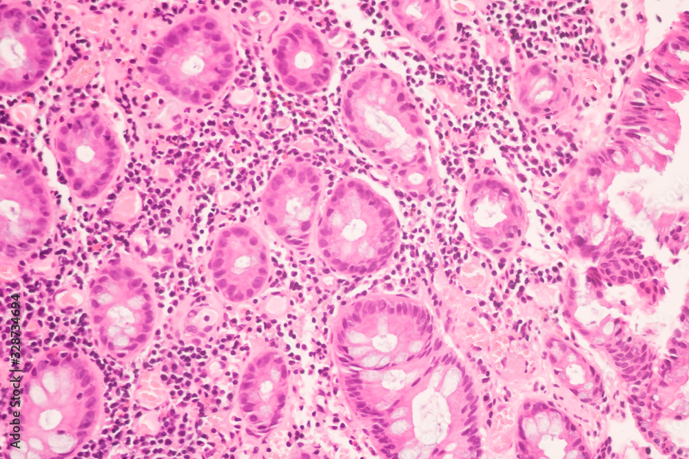 View in microscopic of ductal cell carcinoma, adenonocarcinoma from human breast cancer, tissue section by H and E stain.Pathology diagnosis.Medical concept. Under microscope, magnification 600X View in microscopic of ductal cell carcinoma, adenonocarcinoma from human breast cancer, tissue section by H and E stain.Pathology diagnosis.Medical concept. Under microscope, magnification 600X