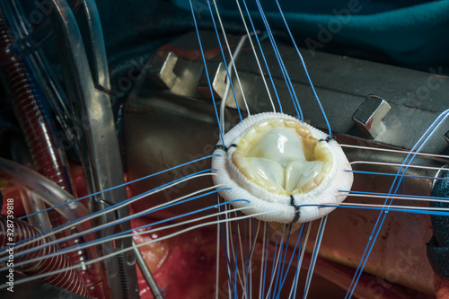 Heart valve prosthesis. Close up image of aortic valve implant during open heart surgery.