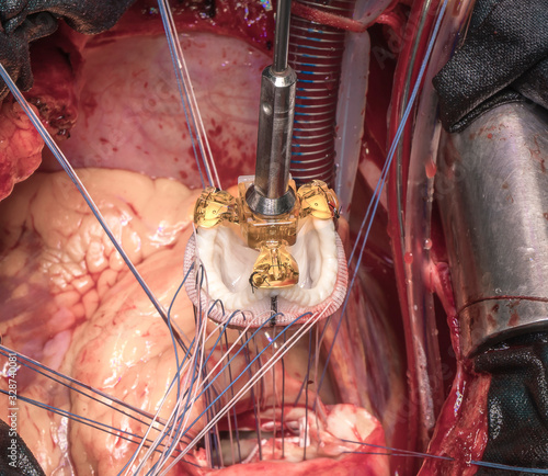 Artificial heart valve. Close up view. photo