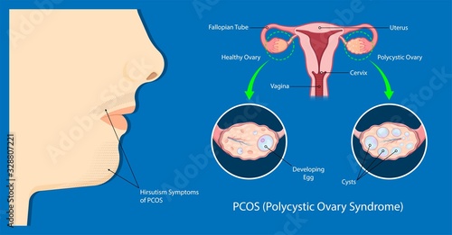polycystic ovary syndrome PCOS hormonal diagnose diagnostic exam abnormal cancer fertility cysts physical organs blood transducer probe abdominal bleeding pain ectopic pregnancy uterine