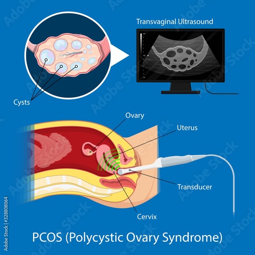 polycystic ovary syndrome PCOS hormonal diagnose diagnostic exam abnormal cancer fertility cysts physical organs blood transducer probe abdominal bleeding pain ectopic pregnancy uterine