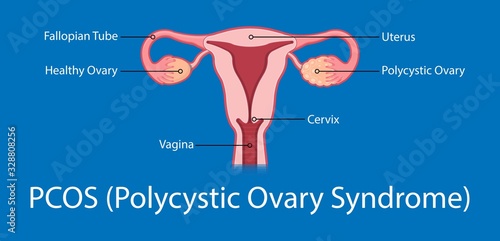 polycystic ovary syndrome PCOS hormonal diagnose diagnostic exam abnormal cancer fertility cysts physical organs blood transducer probe abdominal bleeding pain ectopic pregnancy uterine