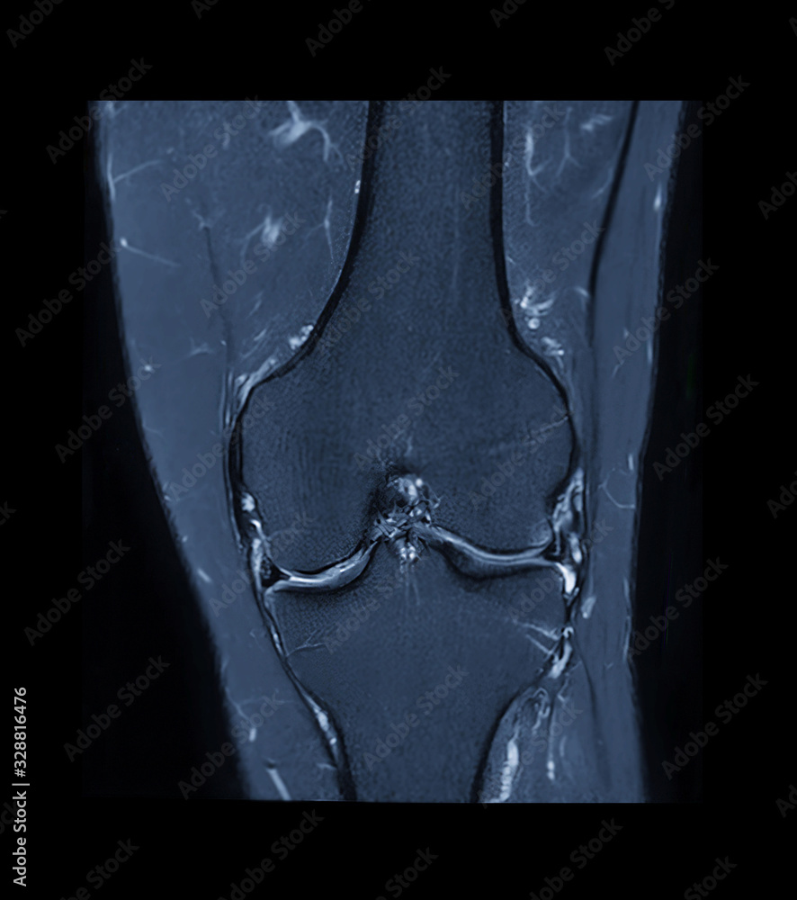 Compare of MRI knee or Magnetic resonance imaging of knee joint stir ...
