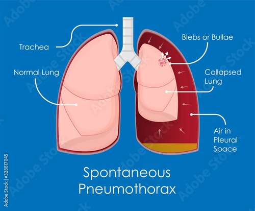 Symptom Spontaneous Iatrogenic Traumatic Pneumothorax Patient with Needle Aspiration Chest Intercostal Drainage Tube Treatment Care Medical Emergency Diagnosis X-Ray Collapsed Lung
