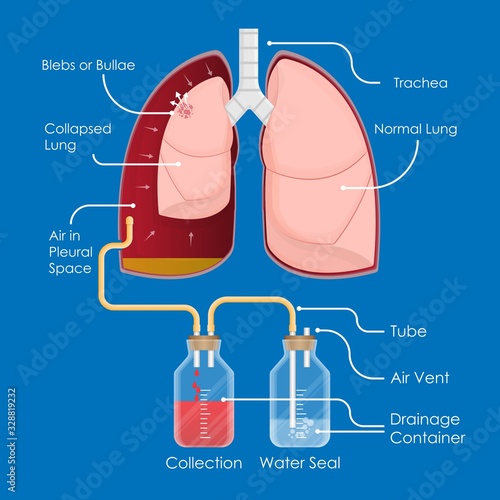 Symptom Spontaneous Iatrogenic Traumatic Pneumothorax Patient with Needle Aspiration Chest Intercostal Drainage Tube Treatment Care Medical Emergency Diagnosis X-Ray Collapsed Lung