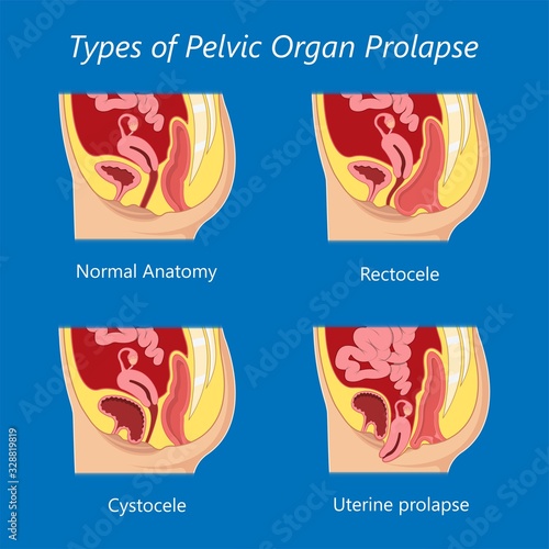 Pelvic floor prolapse type uterine uterus biofeedback pelvic floor treatment stage degree Kegel exercise surgery surgical therapy disorder cystocele urethrocele vaginal vault enterocele urethral exam