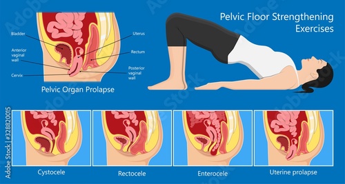 Pelvic floor prolapse type uterine uterus biofeedback pelvic floor treatment stage degree Kegel exercise surgery surgical therapy disorder cystocele urethrocele vaginal vault enterocele urethral exam