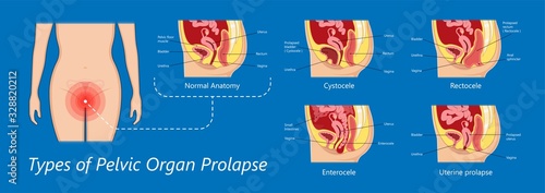 Pelvic floor prolapse type uterine uterus biofeedback pelvic floor treatment stage degree Kegel exercise surgery surgical therapy disorder cystocele urethrocele vaginal vault enterocele urethral exam