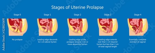 Pelvic floor prolapse type uterine uterus biofeedback pelvic floor treatment stage degree Kegel exercise surgery surgical therapy disorder cystocele urethrocele vaginal vault enterocele urethral exam