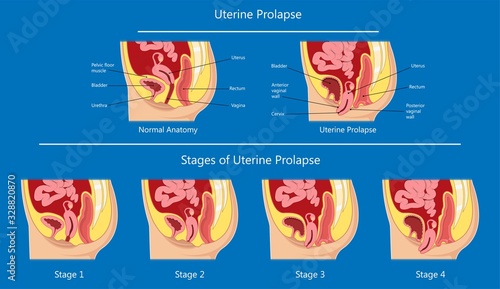 Pelvic floor prolapse type uterine uterus biofeedback pelvic floor treatment stage degree Kegel exercise surgery surgical therapy disorder cystocele urethrocele vaginal vault enterocele urethral exam