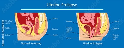 Pelvic floor prolapse type uterine uterus biofeedback pelvic floor treatment stage degree Kegel exercise surgery surgical therapy disorder cystocele urethrocele vaginal vault enterocele urethral exam