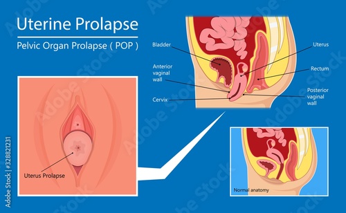Pelvic floor prolapse type uterine uterus biofeedback pelvic floor treatment stage degree Kegel exercise surgery surgical therapy disorder cystocele urethrocele vaginal vault enterocele urethral exam