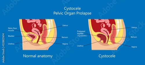 Pelvic floor prolapse type uterine uterus biofeedback pelvic floor treatment stage degree Kegel exercise surgery surgical therapy disorder cystocele urethrocele vaginal vault enterocele urethral exam