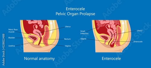 Pelvic floor prolapse type uterine uterus biofeedback pelvic floor treatment stage degree Kegel exercise surgery surgical therapy disorder cystocele urethrocele vaginal vault enterocele urethral exam