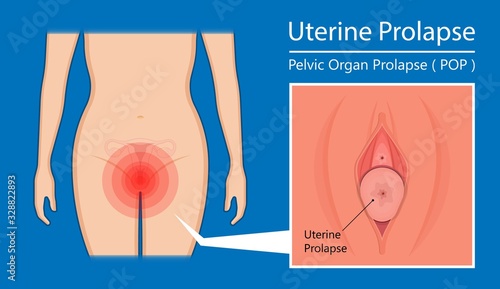 Pelvic floor prolapse type uterine uterus biofeedback pelvic floor treatment stage degree Kegel exercise surgery surgical therapy disorder cystocele urethrocele vaginal vault enterocele urethral exam