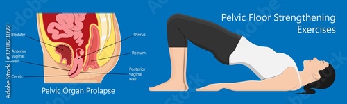 Pelvic floor prolapse type uterine uterus biofeedback pelvic floor treatment stage degree Kegel exercise surgery surgical therapy disorder cystocele urethrocele vaginal vault enterocele urethral exam