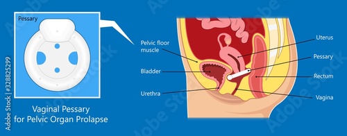 Pelvic floor prolapse type uterine uterus biofeedback pelvic floor treatment stage degree Kegel exercise surgery surgical therapy disorder cystocele urethrocele vaginal vault enterocele urethral exam photo