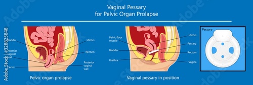 Pelvic floor prolapse type uterine uterus biofeedback pelvic floor treatment stage degree Kegel exercise surgery surgical therapy disorder cystocele urethrocele vaginal vault enterocele urethral exam