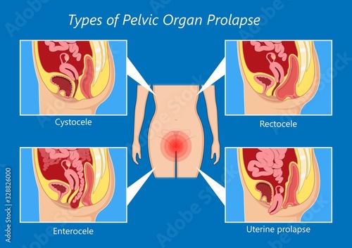 Pelvic floor prolapse type uterine uterus biofeedback pelvic floor treatment stage degree Kegel exercise surgery surgical therapy disorder cystocele urethrocele vaginal vault enterocele urethral exam
