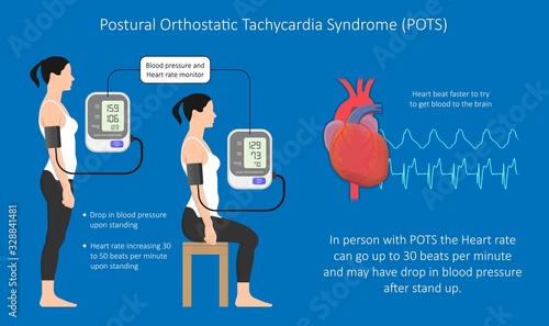 Postural Orthostatic Tachycardia Syndrome POTS intolerance tilt table test Dysautonomia low volume diagnosed measure pulse abnormal fast vessels fainting lightheadedness dizziness procedure breathing