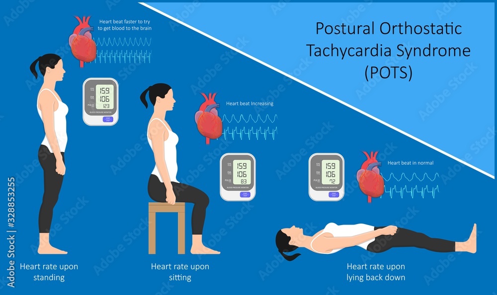 Postural Orthostatic Tachycardia Syndrome POTS intolerance tilt table test  Dysautonomia low volume diagnosed measure pulse abnormal fast vessels  fainting lightheadedness dizziness procedure breathing Stock Vector