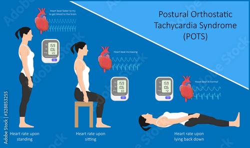 Postural Orthostatic Tachycardia Syndrome POTS intolerance tilt table test Dysautonomia low volume diagnosed measure pulse abnormal fast vessels fainting lightheadedness dizziness procedure breathing