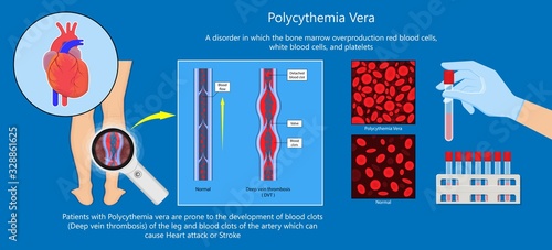Polycythemia vera PV blood clots cancer bone marrow diagnostic complete count venous thromboses
