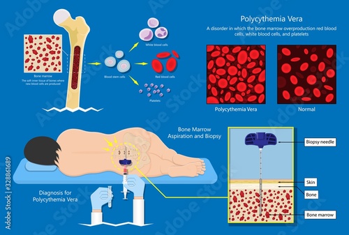 Polycythemia vera PV blood clots cancer bone marrow diagnostic complete count venous thromboses